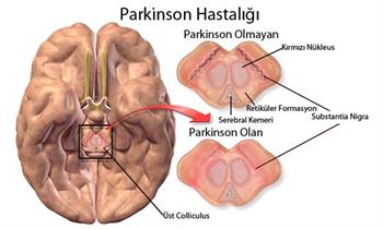  Parkinsona "elektrotlu çözüm"  getirildi